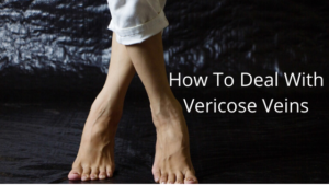 varicose veins